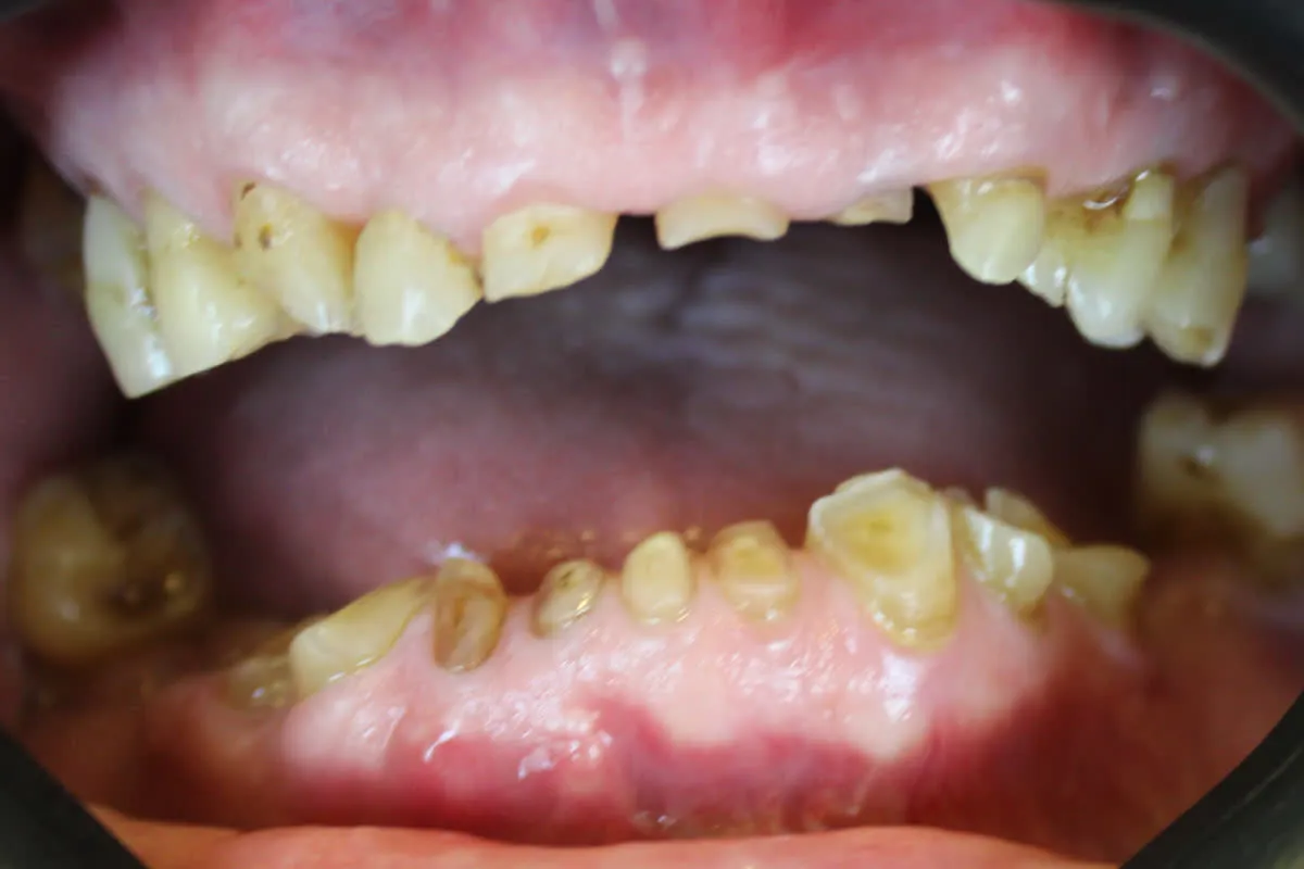 Arcada do paciente antes, com dentes comprometidos
