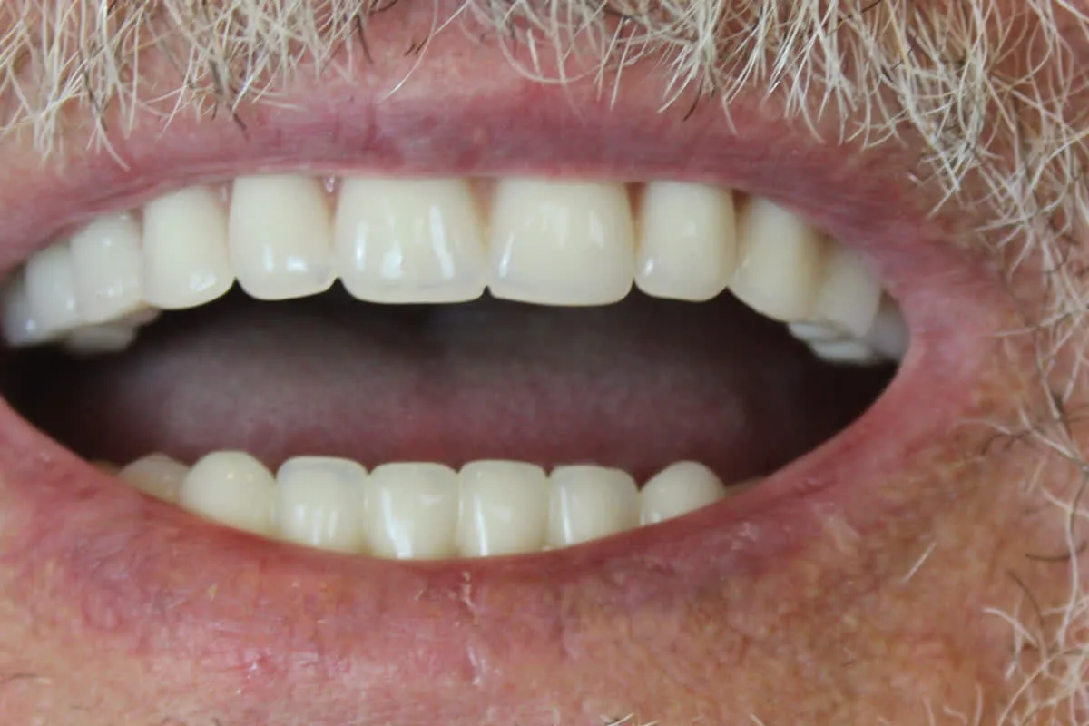 Arcada do paciente depois, com os dentes reabilitados